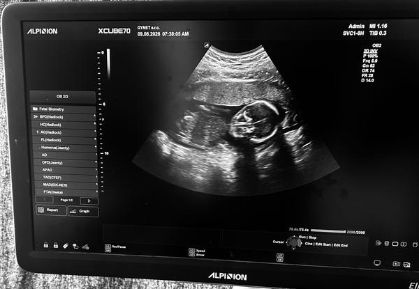 Je viditeľné pohlavie dieťaťa na ultrazvuku v 16 týždni?