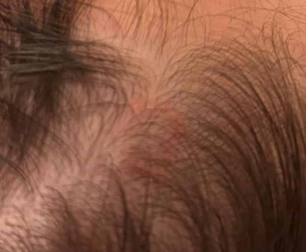 Ako riešiť svrbivé fľaky vo vlasoch?