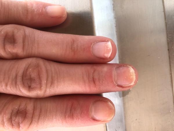 Laserové odstránenie mykózy nechtov na rukách