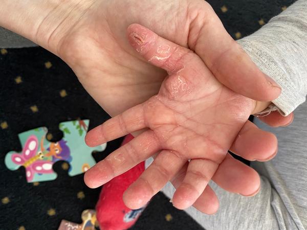 Aký krém odporúčate na suché rúčky 1,5 ročnej dcérky?