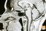 Magnetická rezonancia mozgu s kontrastnou látkou