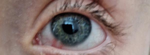 Nechcú vyšetriť syna s kiahňami v oku?