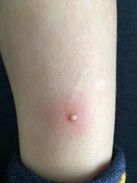 Poraďte čo to je za vyrážku na nohe