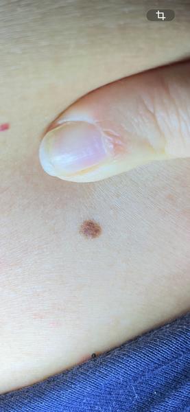 Môže byť toto znamienko nebezpečné?