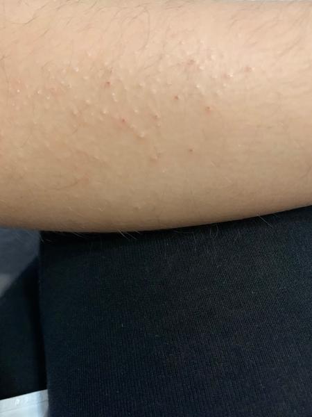 Ide o alergiu na potraviny?