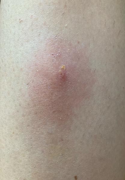 Mám na nohe opuch. Čo to môže byť?