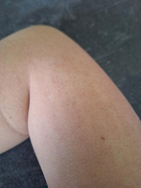 Čo môže byť na mojej ruke?