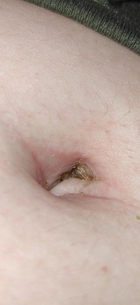 Mám si robiť starosti s chrastami v bruchu?