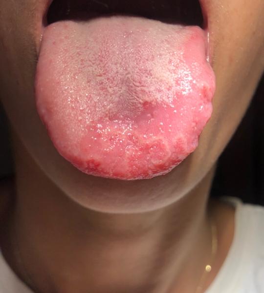 Opakujúci sa trojročný problém - fľaky na jazyku