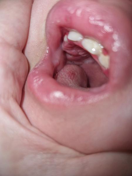 Fľaky na jazyku u 21-mesačného dieťaťa – čo to môže byť?