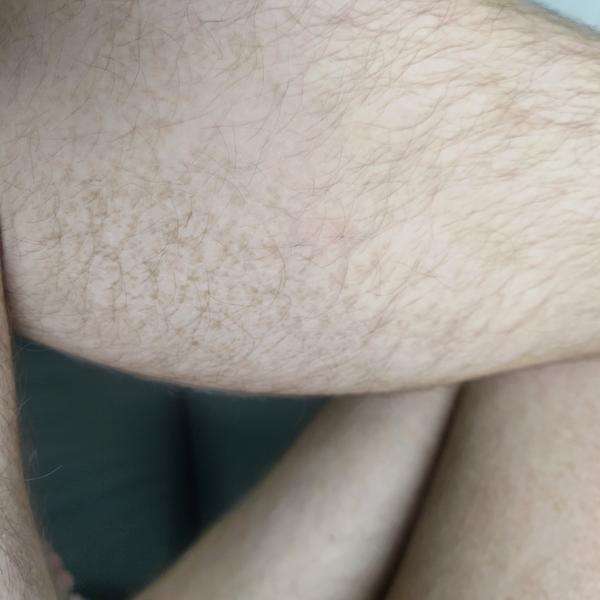 Kožná choroba u 15-ročného