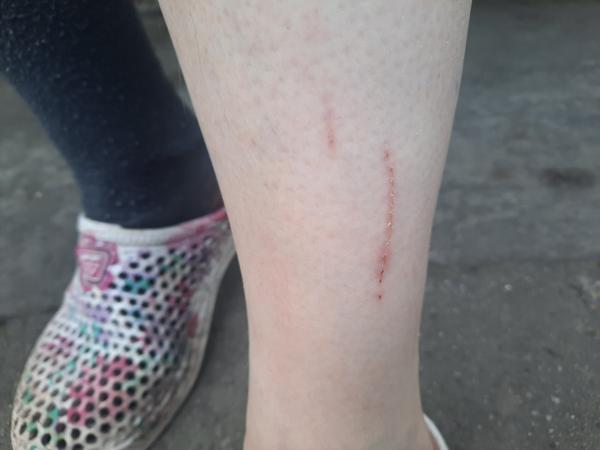 Aké ranky mám na nohách?