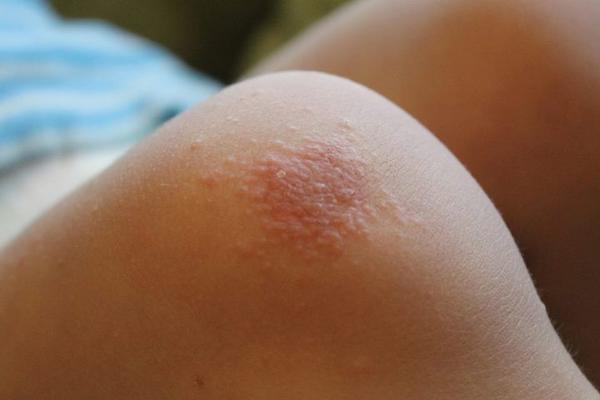 Aký kožný problém je toto?