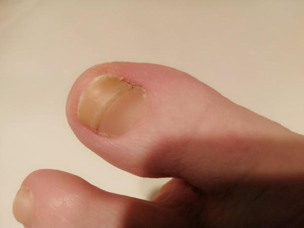 Čo s týmto nechtom?