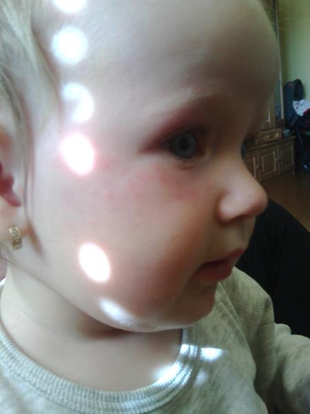 Fliačiky na tváričke