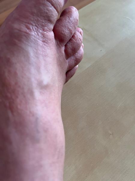 Môže ísť o dyshidrotický ekzém?