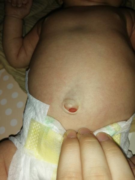 Pľuzgier v pupčeku