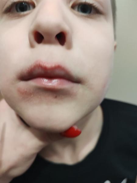 Čo pomáha na kožné problémy u detí?