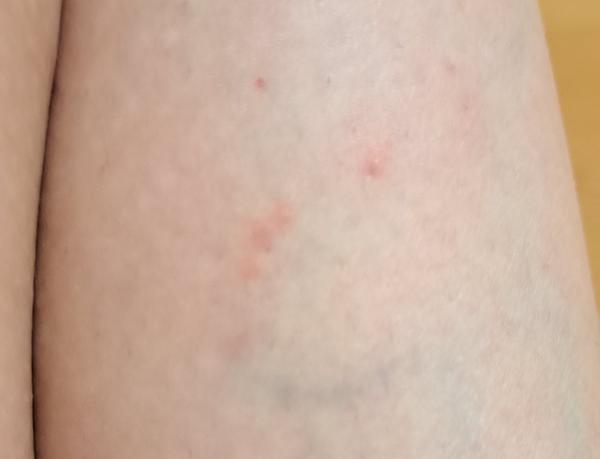 Ako sa zbaviť malých vyrážok po celom tele?