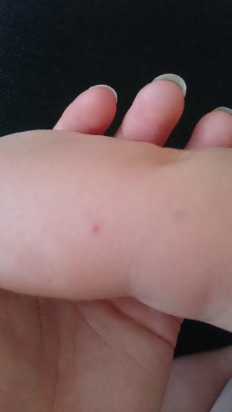 Môžu to byť kiahne?