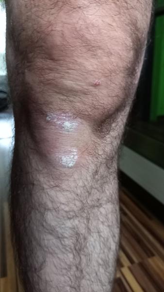 Ako zmäkčiť stvrdnutú kožu na kolenách?