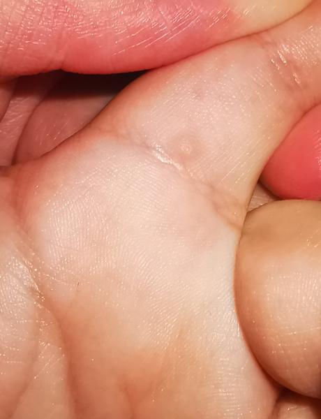 Čo spôsobuje podozrivú vyrážku na ruke syna?