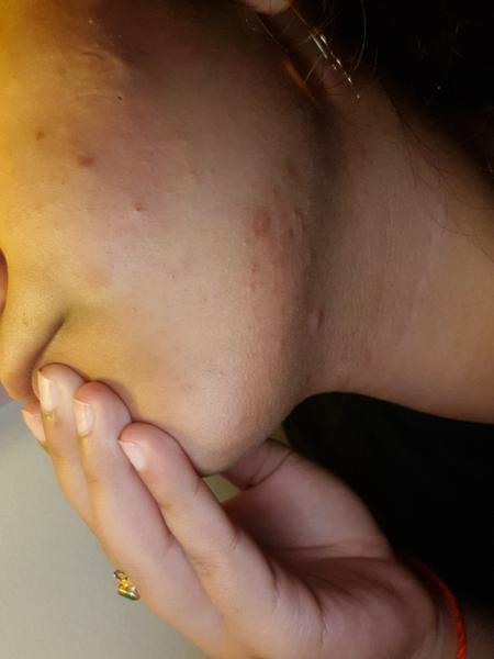 Ako riešiť hnisavé vyrážky?