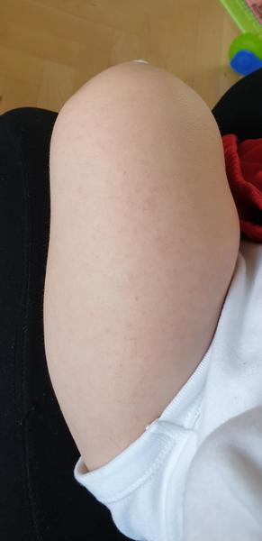 Čo za výrážky má dcérka na rukách a na nohách?