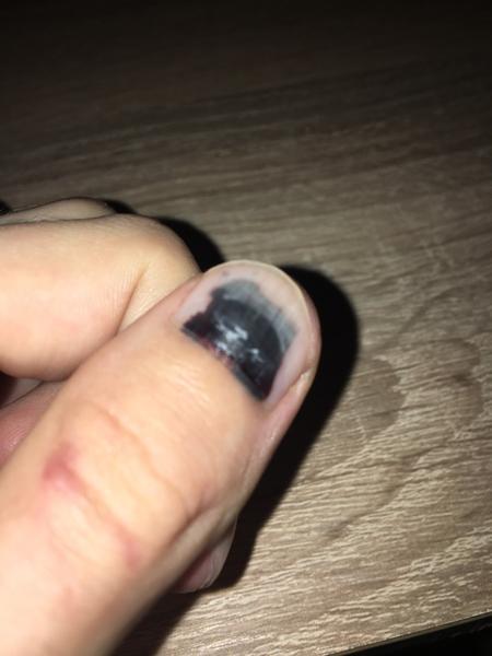 Zabuchla som si palec o dvere a vznikol mi hematóm. Mám ísť k doktorke?