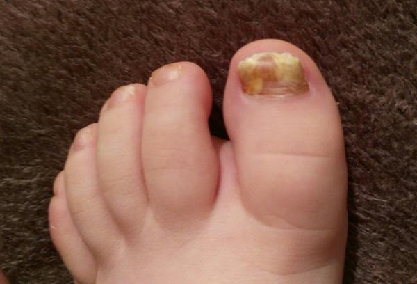 Ako liečiť zničený necht?