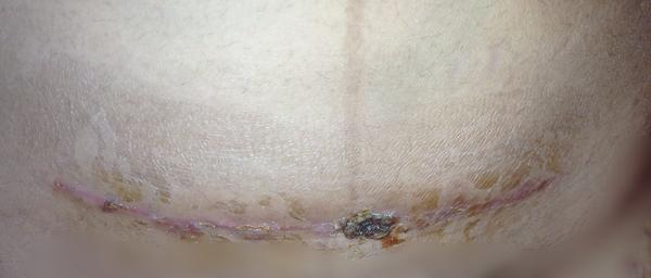 Cisársky rez - hojenie rany