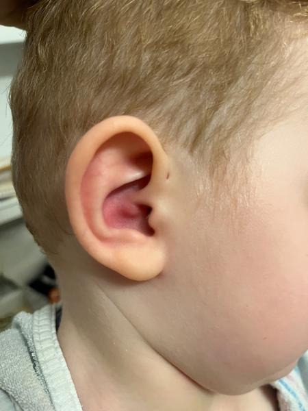 Je potrebné ísť s modrinou v uchu na pohotovosť?