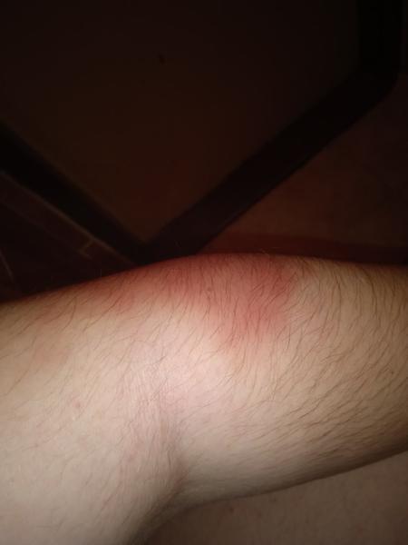 Spadla som zo schodov. Mám ísť do nemocnice?