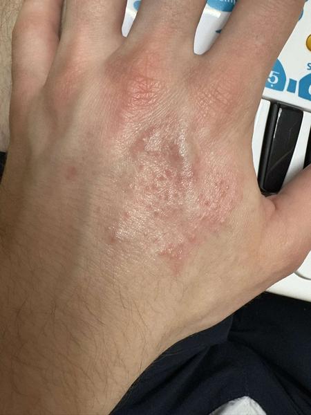 Má niekto skúsenosť s ekzémom?