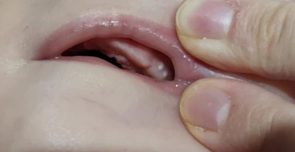 Čo znamenajú dva biele hrbolčeky na vrchnom ďasne u mojej dcérky?