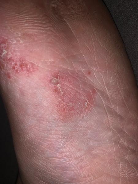 Kožné ochorenie nohe - čo si na to dať?