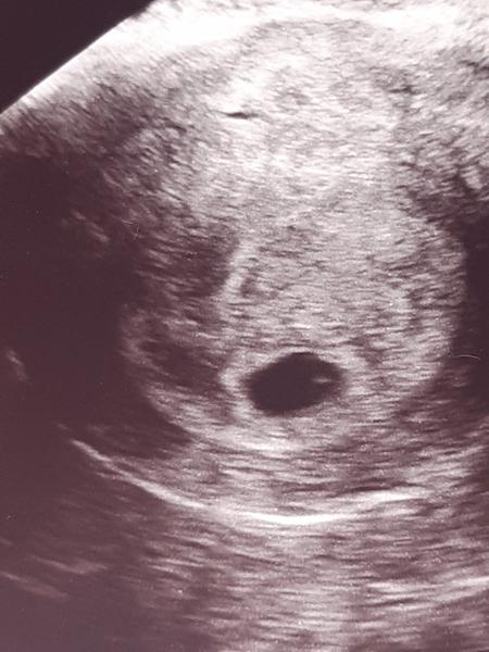 Vidím dva vaky. Čakám dvojčatá?