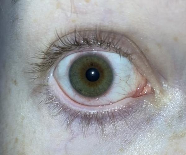 Popraskané cievky v oku