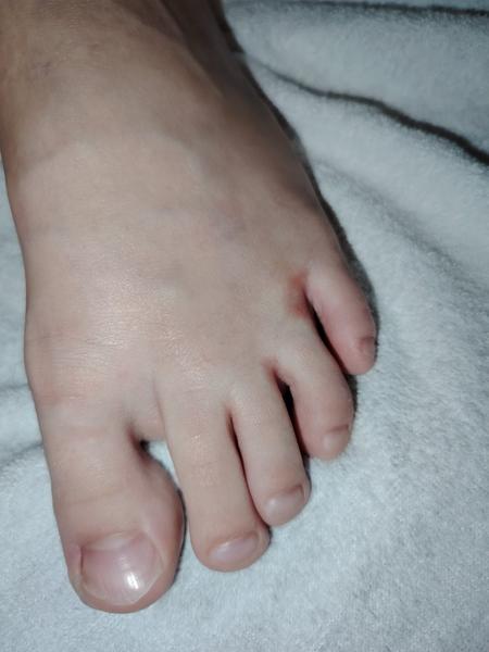 Tipy na liečbu mykózy na nohách u dieťaťa