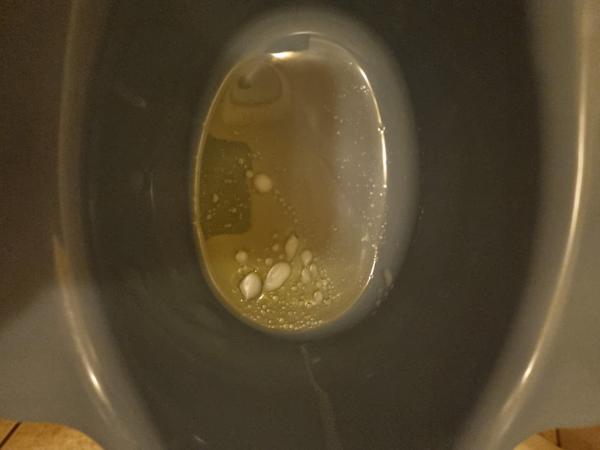 Syn má teplotu a zmeny v moči: Kedy navštíviť pohotovosť?