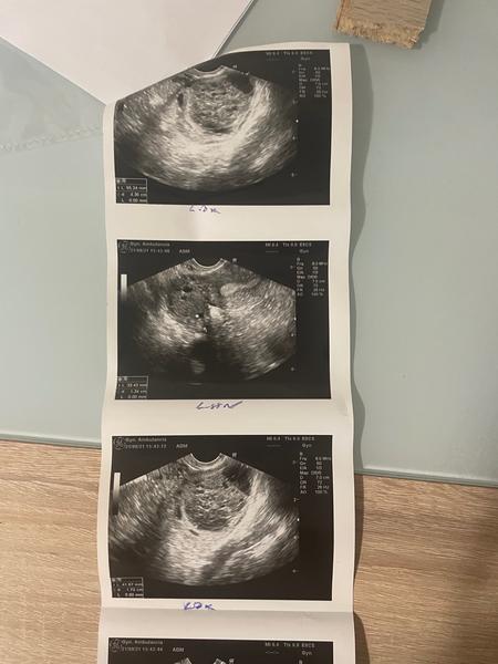 Je šanca prirodzene otehotnieť, keď mám posunutú ovuláciu?