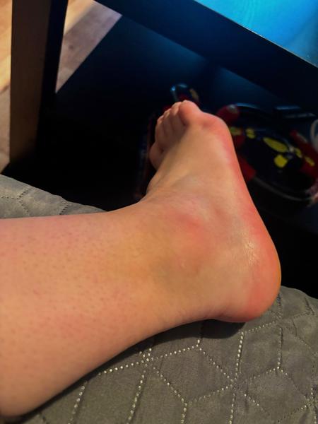 Je nutné navštíviť pohotovosť pri zranenom členku?