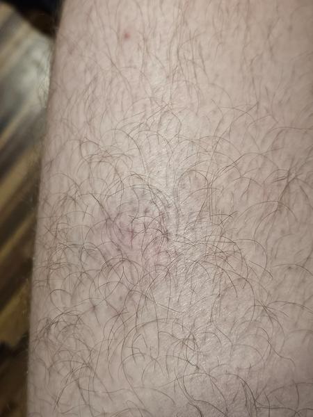 Modrina na nohe bez zjavnej príčiny