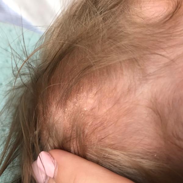 Aké šupinky má môj 2,5 mesačný synček na hlavičke?