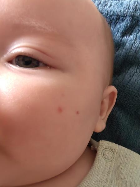 Bodky na líčku 3-mesačného bábätka