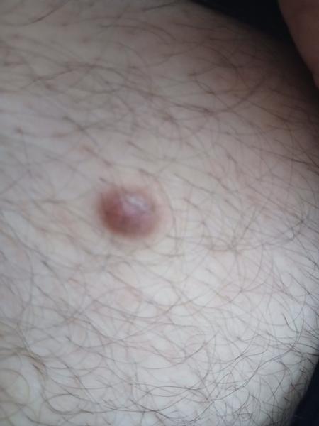 Čo spôsobuje dlhotrvajúce zranenia po bitke?