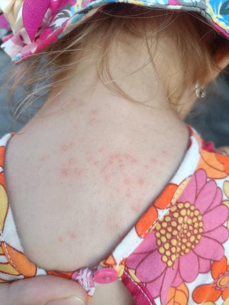 Sú to skutočne potničky za krkom?