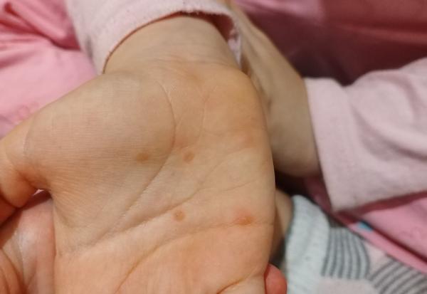 Ako liečiť afty a molusky u detí?