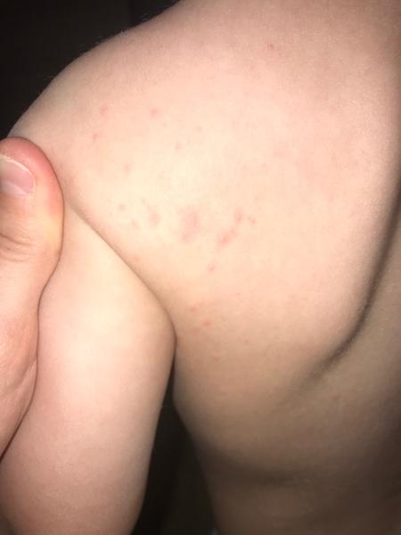 Zvracanie a teraz vyrážky