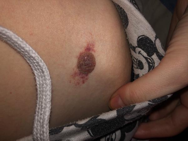 Ak postupovať, keď som si buchla znamienko o dvere?